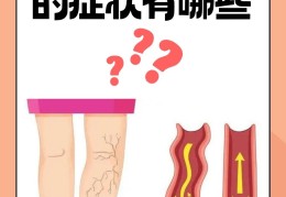 静脉曲张健康宣教ppt的简单介绍