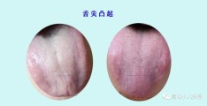 李茂发治疗漏尿遗尿(李茂发治漏尿最经典十句话)