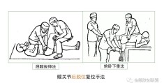 腰椎滑脱整复手法(腰椎滑脱手法复位后怎么保养)