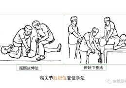 腰椎滑脱整复手法(腰椎滑脱手法复位后怎么保养)