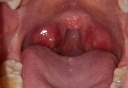 李茂发治咽炎治疗视频(李茂发一病一方治咳嗽肺炎)