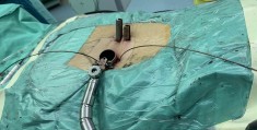 腰椎间盘滑脱复位手法视频(腰椎间盘滑脱推拿,复位手法)