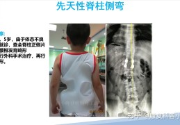 脊柱侧弯李华(脊柱侧弯典型案例)